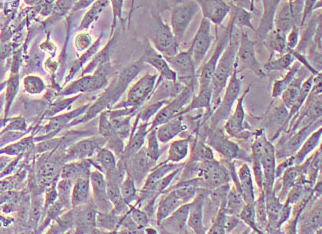 人胰腺神经内分泌肿瘤细胞永生化 Immortalization of human pancreatic neuroendocrine tumor cells